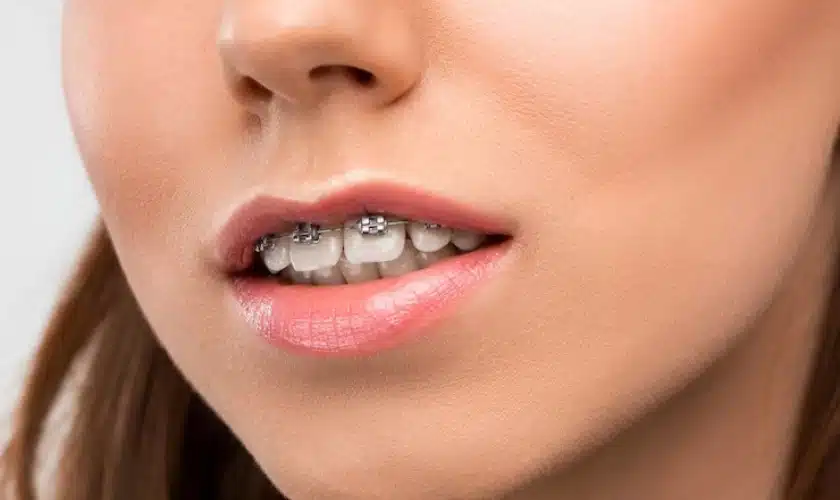 Aligning Your Smile Naturally: Benefits of Holistic Titanium Braces