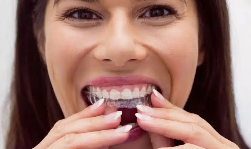 5 Reasons Why You Should Consider Having Clear Aligners