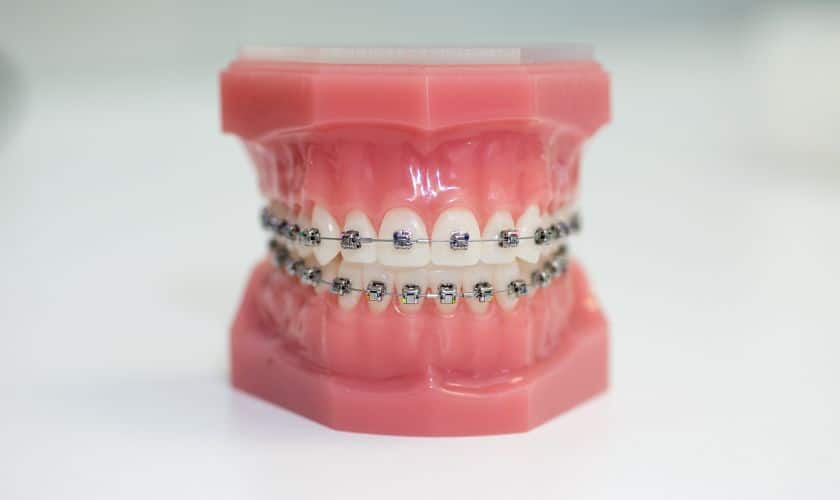 Myths and truths of ceramic or transparent brackets - Wilmington