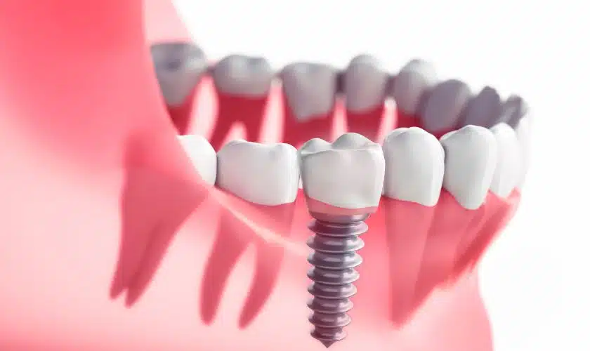 Dental Implant Treatment Alternatives For Missing Teeth