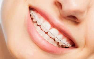 Benefits Of Clear Braces: A Discreet Solution For Straightening Your Smile